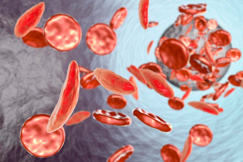 Sickle cell disease is now curable, but the treatment is