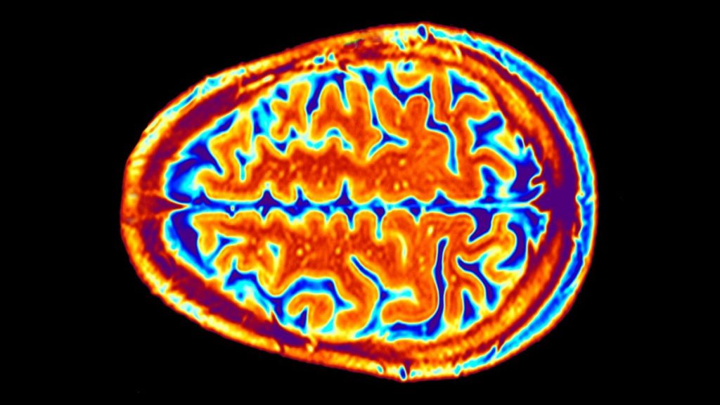 ‘Smoothness’ in parts of brain’s surface may boost risk of