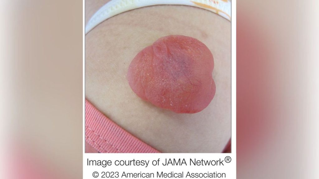 Rare red tumor on girl’s arm oozed ‘jellylike substance’ when