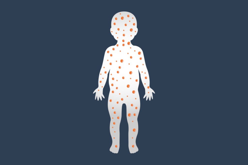 An Alarming Rise in Measles Cases Is Being Driven By